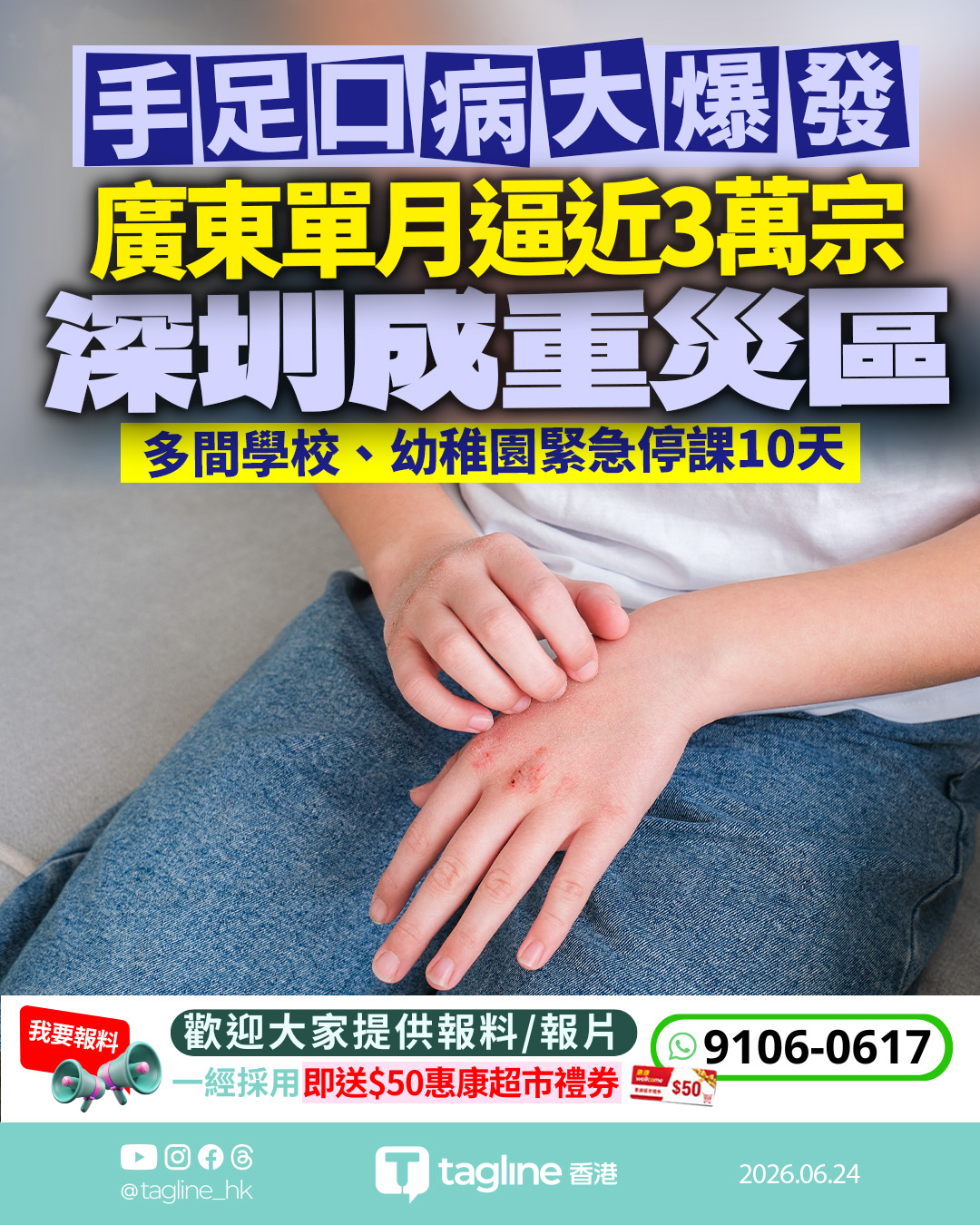 手足口病肆虐廣東單月錄近3萬宗 深圳成重災區多校緊急停課10天