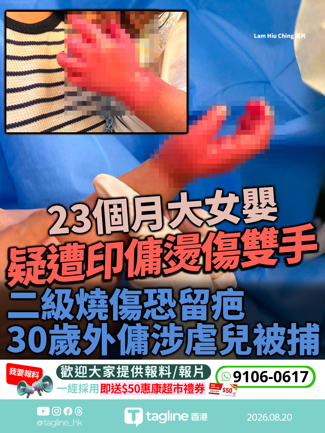 元朗23個月大女嬰疑遭印傭燙傷雙手 二級燒傷恐留疤 30歲外傭涉虐兒被捕